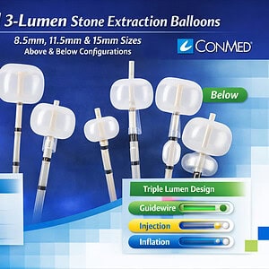 ConMed 3-Lumen Stone Extraction Balloons — Above & Below Configurations (8.5mm, 11.5mm, 15mm)